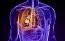 Three NSCLC indications included in positive CHMP opinion for tislelizumab