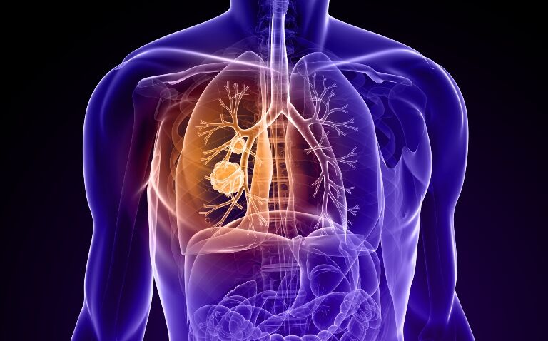 Three NSCLC indications included in positive CHMP opinion for tislelizumab
