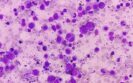 Dr Sara Ghorashian on tisagenlecleucel and acute lymphoblastic leukaemia innovations