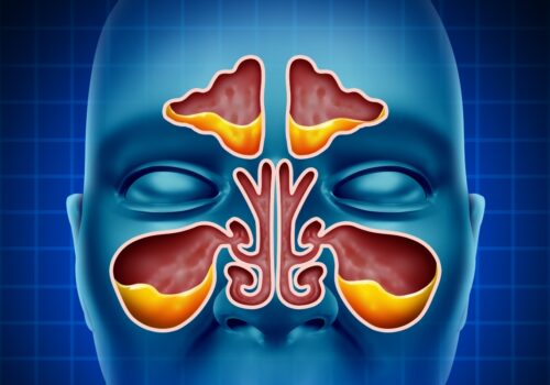 A digital illustration of a human face with the sinuses highlighted in red and filled with yellow mucus to illustrate chronic rhinosinusitis and insights from the MACRO trial|A table containing a proposed CRS care pathway from primary to tertiary care