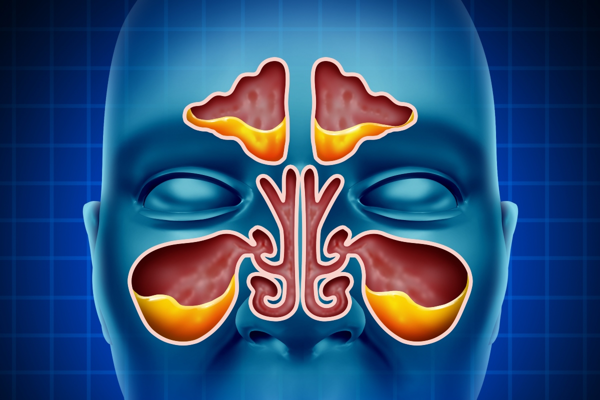 A digital illustration of a human face with the sinuses highlighted in red and filled with yellow mucus to illustrate chronic rhinosinusitis and insights from the MACRO trial|A table containing a proposed CRS care pathway from primary to tertiary care