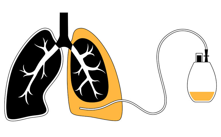 Illustration of lungs showing a pleural effusion in the right lung being drained through a catheter connected to a fluid collection bag to represent a national review of pleural procedures and safety concerns