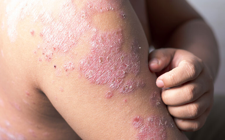 Image depicting psoriasis on upper arm