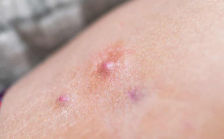 Adalimumab dose increase more effective in obese hidradenitis suppurativa patients