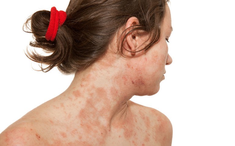 Adherence to NICE criteria for dupilumab biologic treatment in atopic dermatitis