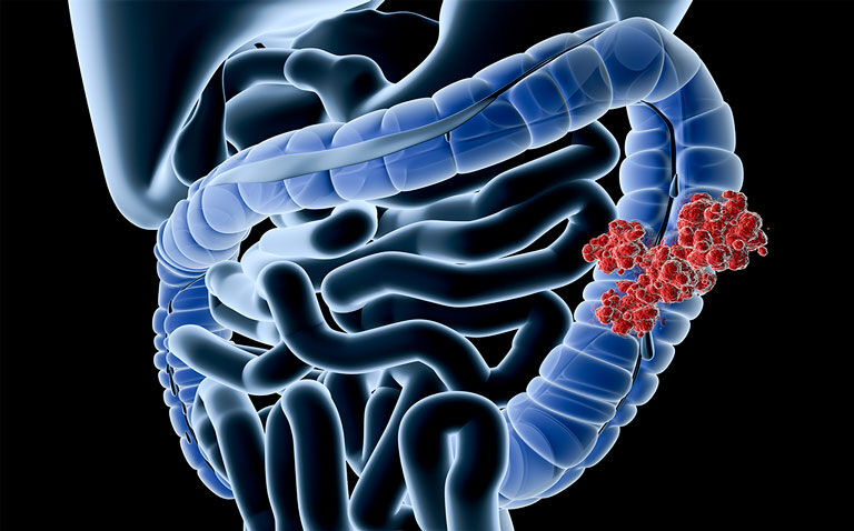 Advanced colon cancer prescribing habits changed following IDEA collaboration study