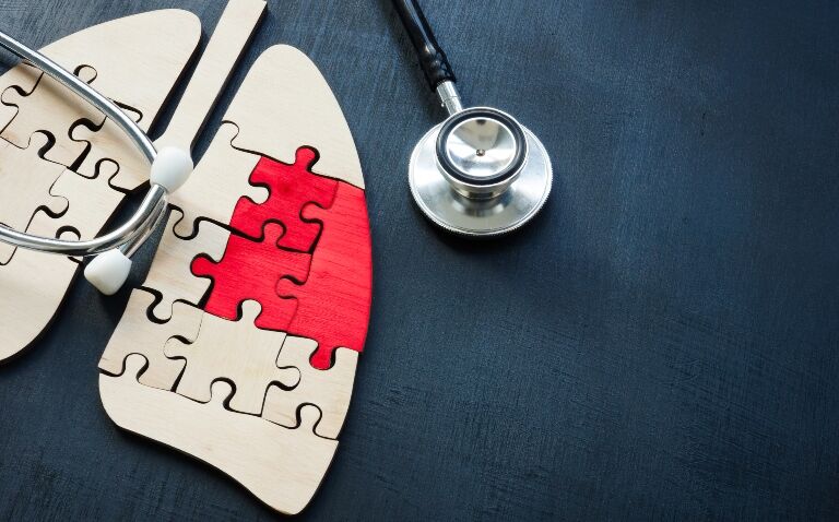 Alectinib shows promise in early-stage ALK-positive non-small cell lung cancer