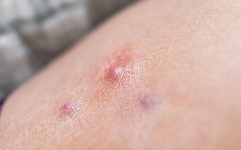 Bimekizumab gains EC approval for hidradenitis suppurativa