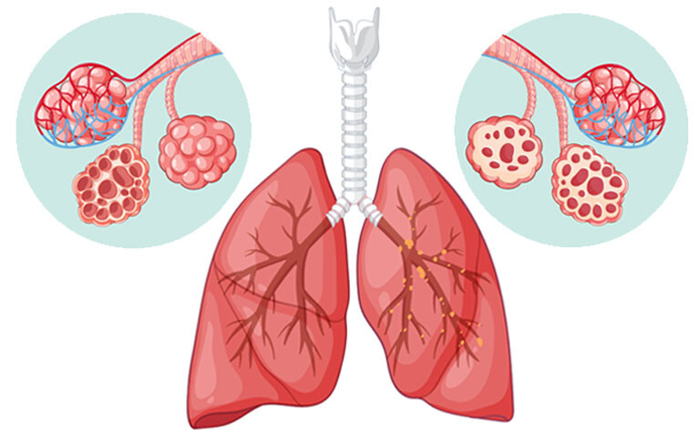 A digital illustration of human lungs and a healthy alveoli in a blue circle on the left and an alveoli affected by IPF in a blue circle on the right to illustrate new registry data supporting the development of personalised treatment for patients