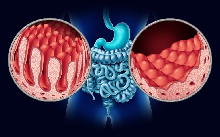 A digital illustration of a human body with the gastrointestinal tract highlighted in blue and two circles overlayed showing a healthy intestine in one and a coeliac disease affected intestine in the other to illustrate a new coeliac disease diagnostic pathway that utilises AI