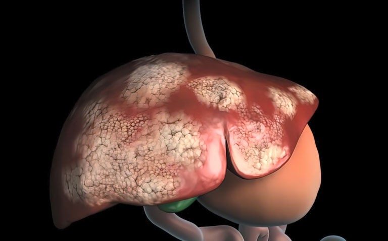 CTX-009 shows promise in biliary tract cancer