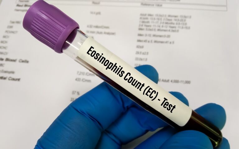 A person wearing a blue glove holding a test tube of blood with a label saying eosinophil count (EC) test to illustrate the changing chronic asthma guideline recommendations for diagnosis and management