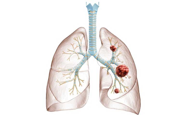 https://hospitalhealthcare.com/news/liquid-biopsy-could-identify-cancer-patients-at-risk-of-metastatic-disease/