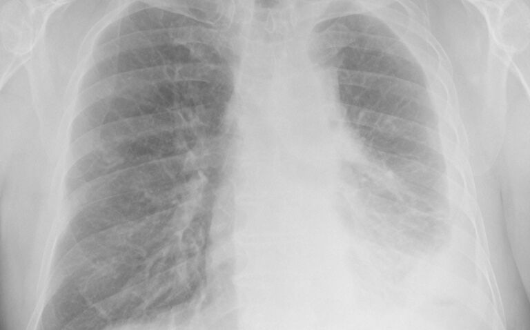 Combination treatment with arginine-depleting agent improves pleural mesothelioma survival