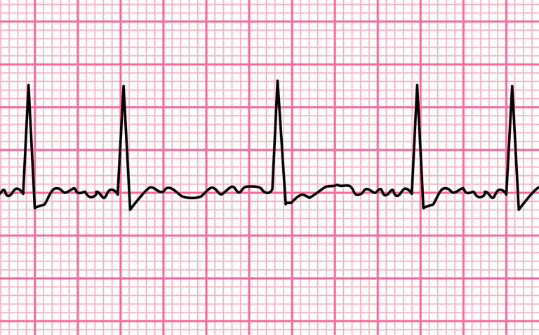 An ECG trace showing atrial fibrillation