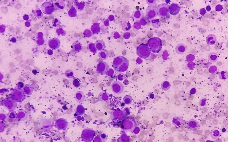 Dr Sara Ghorashian on tisagenlecleucel and acute lymphoblastic leukaemia innovations