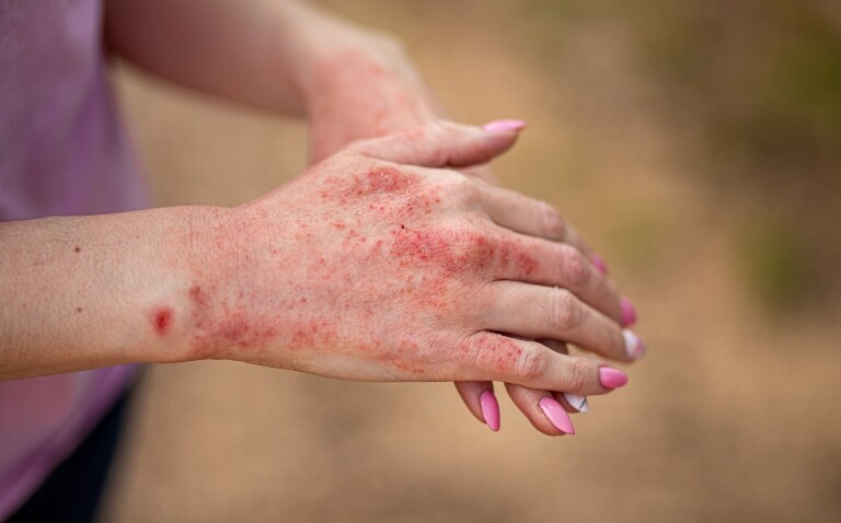 A close up of the hands of a woman in a purple tshirt with one hand on top of the other with moderate-to-severe atopic dermatitis to illustrate the impact of discontinuing dupilumab therapy