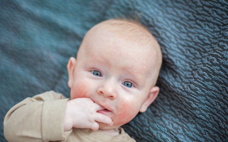 Dupixent approved for severe eczema in children from 6 months