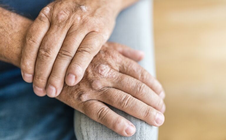 EULAR develops points to consider for psoriasis to psoriatic arthritis transition