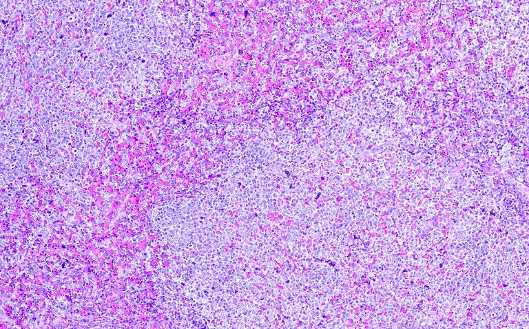 Follicular lymphoma indication granted for zanubrutinib in the EU