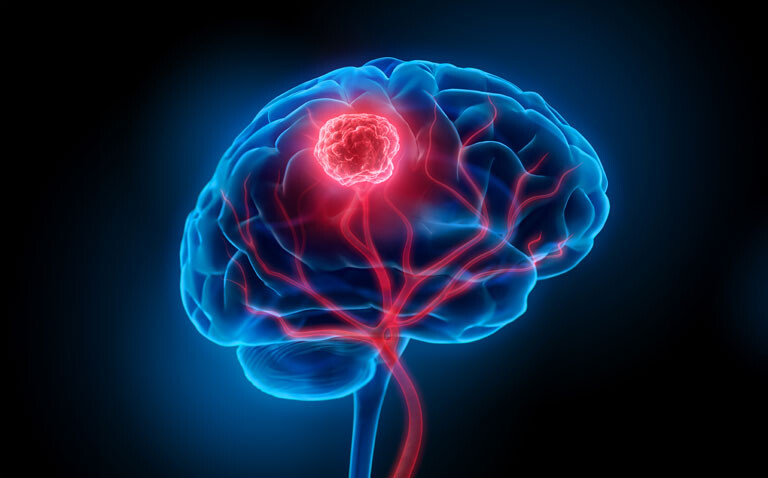 Computer-generated 3D illustration of a human brain with a highlighted tumour in the centre and neural structures to illustrate a game-changing assay for ultra-rapid intraoperative diagnosis of CNS tumours