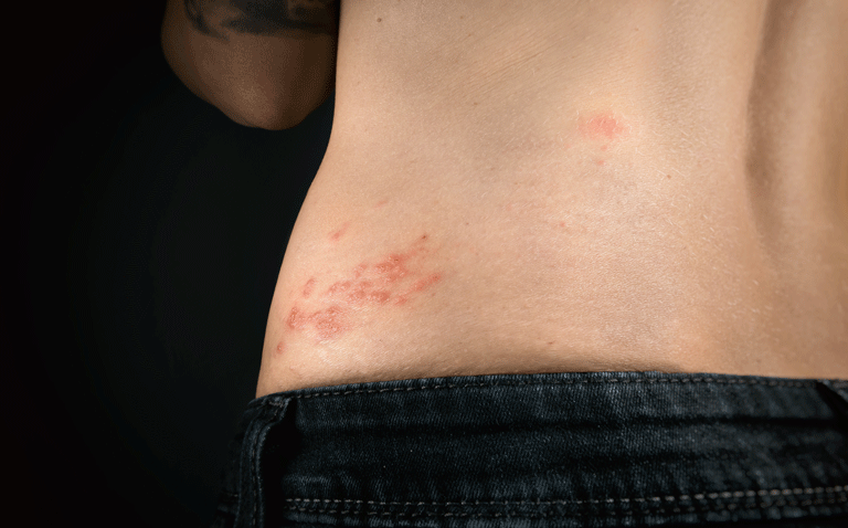 Herpes zoster infection linked to higher risk of stroke and coronary heart disease