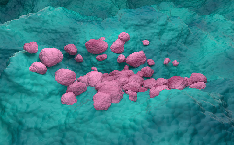 Specific enzyme tissue expression close to tumour may predict survival in NSCLC