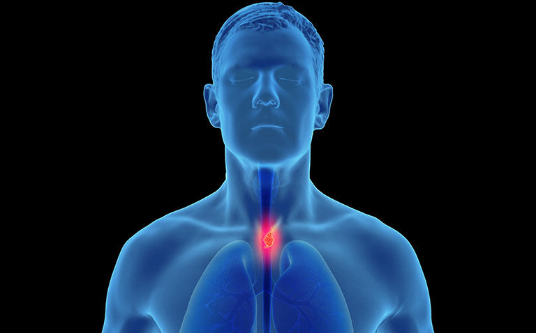 High tumour monocyte content linked to improved survival in oesophageal cancer
