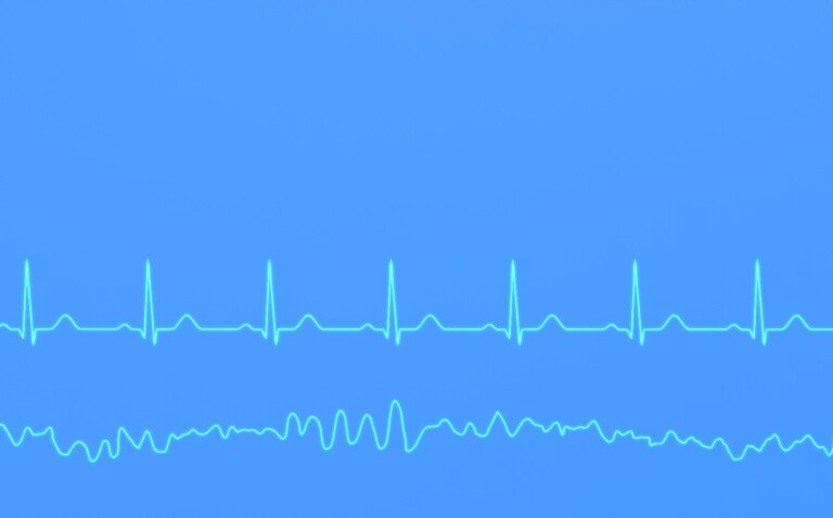 A normal heart rhythm ECG and ventricular fibrillation EGC trace on a blue background to illustrate research suggesting increasing potassium levels can reduce the risk of ventricular arrhythmia in patients with CVD