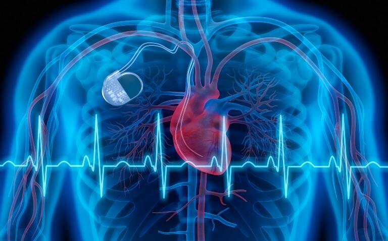 A digital illustration of a semi-transparent blue human body on a black background with the heart highlighted in blue and red and a blue pacemaker positioned above it and an ECG trace over the top to illustrate new research that shows how to personalise CIED choice for patients