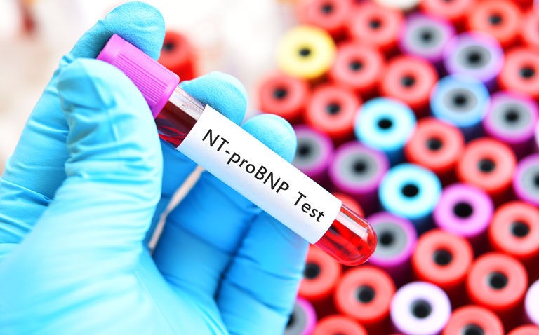 Increased NT-proBNP levels over time linked to greater risk of heart failure and death