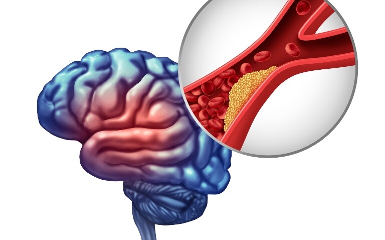 Medical illustration of a grey and red brain and a magnified circle showing a build-up of plaque in the carotid artery that may require revascularisation or just optimal medical therapy for stroke prevention in carotid stenosis