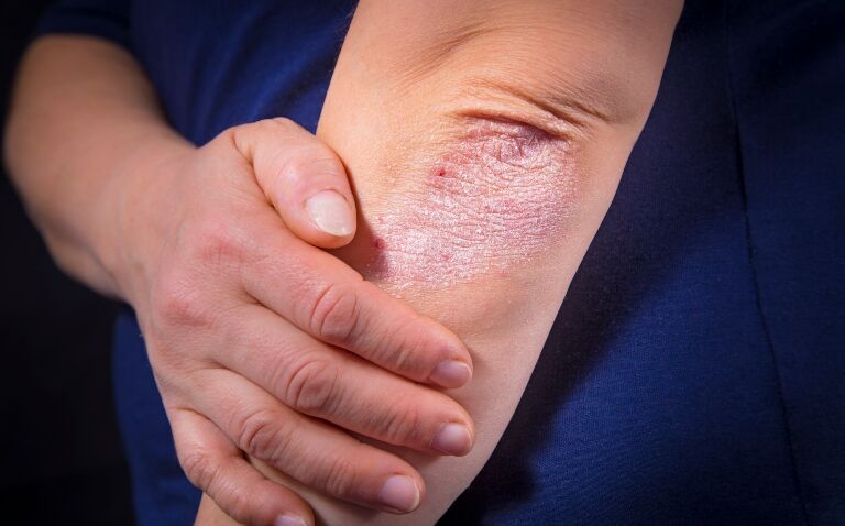 Is topical roflumilast the rising star of dermatological treatments?