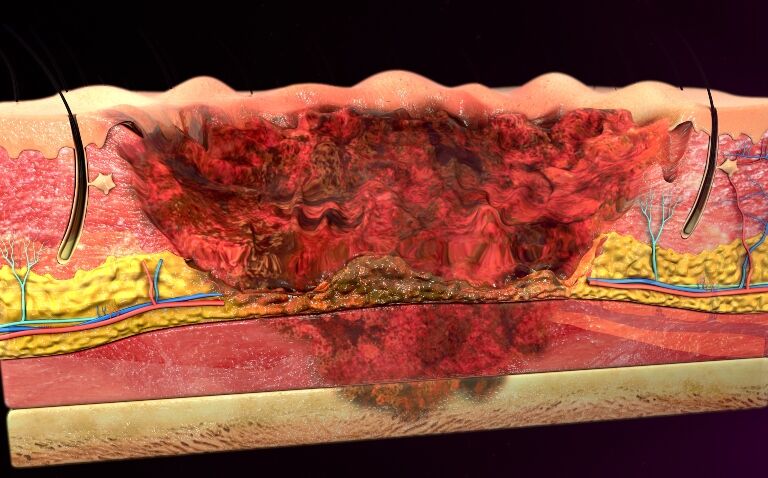 Latest developments in paediatric burn management and enzymatic debridement