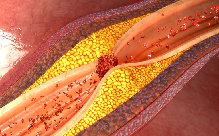 Lifelong endurance exercise associated with unfavourable coronary plaque composition