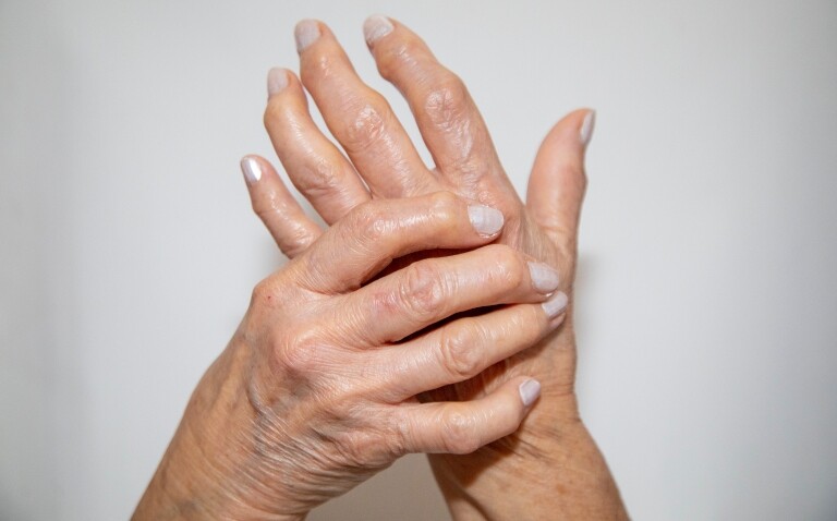 A close up of a woman's hands with rheumatoid arthritis to illustrate the identification of low adherence to CVD risk assessment guidelines in patients with rheumatoid arthritis