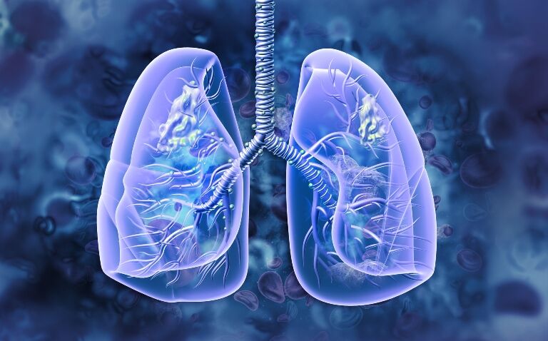 Lung cancer screening could be a ’game changer’ in Scotland