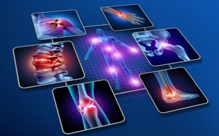 MHRA approves bimekizumab for psoriatic arthritis and axial spondyloarthritis