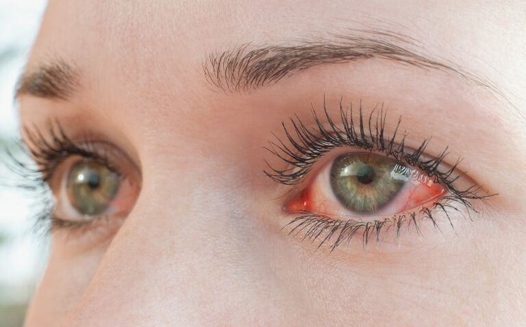 MHRA issues advice as Burkholderia cenocepacia outbreak linked to carbomer eye gels