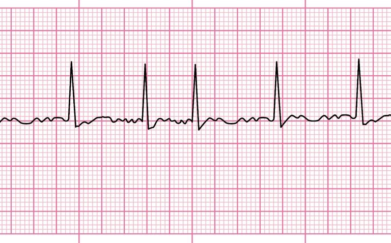 Macrophage expressed gene identified as potential target for atrial fibrillation