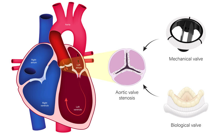 A diagram of a human hear cross section with an illustration of aortic stenosis and a mechanical valve and a biological valve
