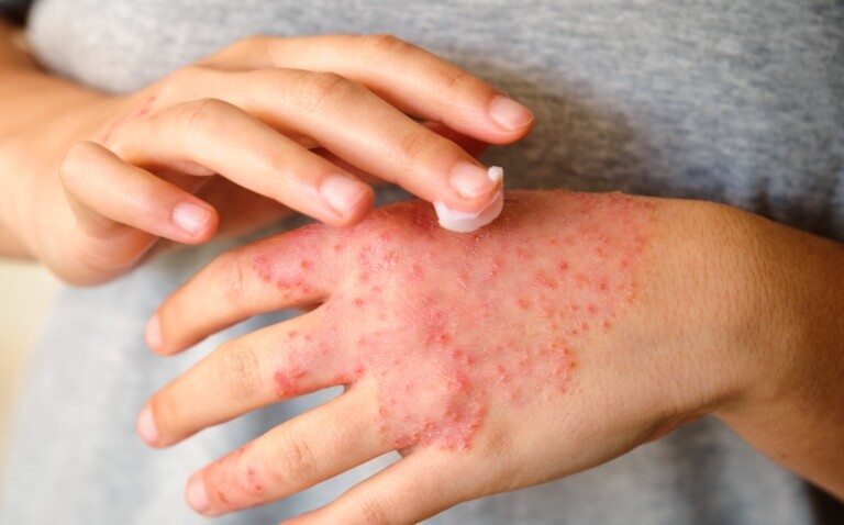 A close up of a woman applying a topical cream to her red and inflamed hands to illustrate the NICE approval of delgocitinib for chronic hand eczema