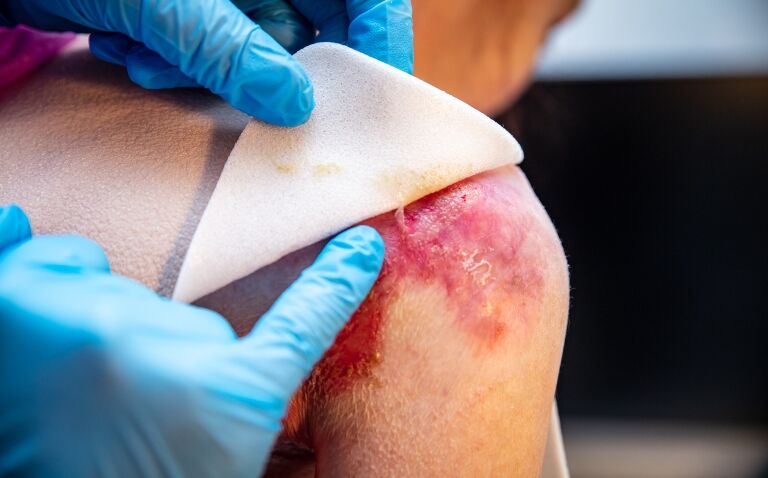 NICE recommends birch bark extract for epidermolysis bullosa-induced wounds
