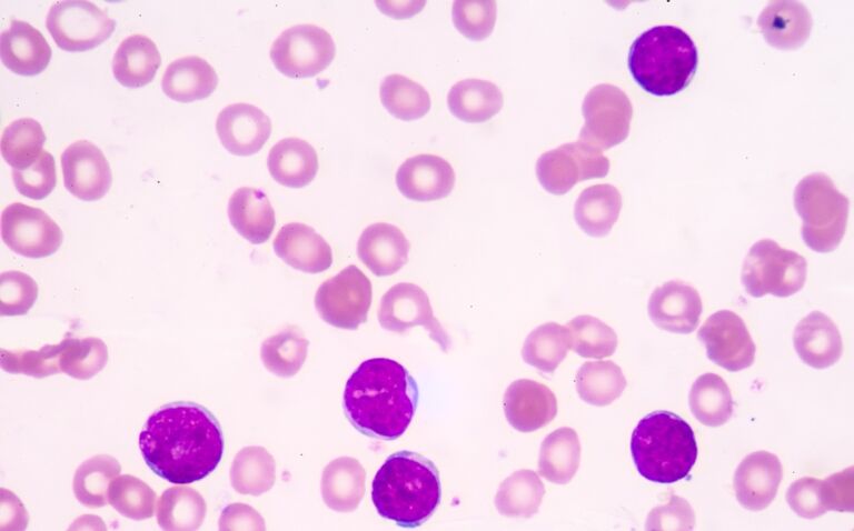 NICE recommends tisagenlecleucel for eligible patients with acute lymphoblastic leukaemia