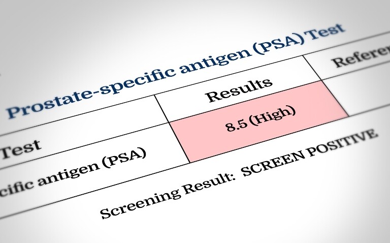 A close up of a prostate specific antigen (PSA) test result showing a positive result of a high reading of 8.5