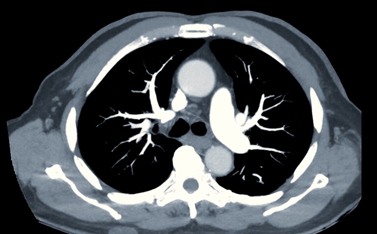 A computed tomographic pulmonary angiography scan which is the gold standard for diagnosing pulmonary embolism