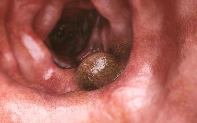 Neoadjuvant chemotherapy improves two-year survival in operable colon cancer