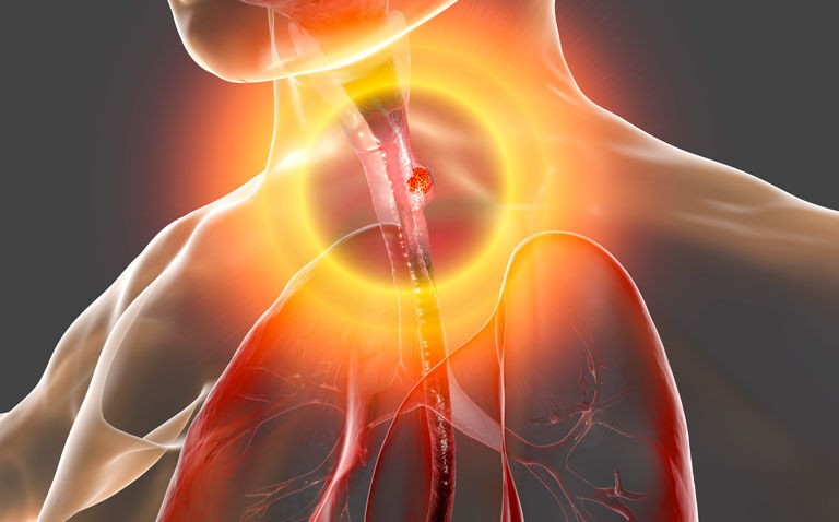 Neoadjuvant socazolimab shows promise for locally advanced oesophageal squamous cell cancer