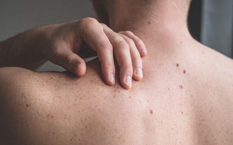 Nivolumab-relatlimab approved by MHRA for advanced melanoma