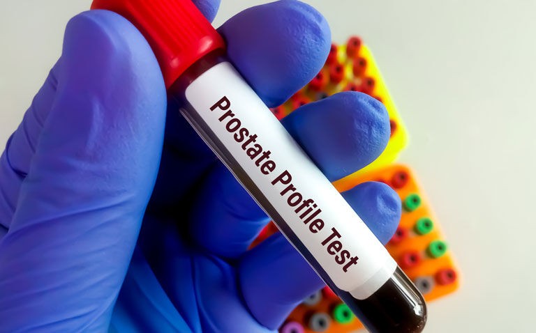 Novel prostate cancer screening test highly accurate